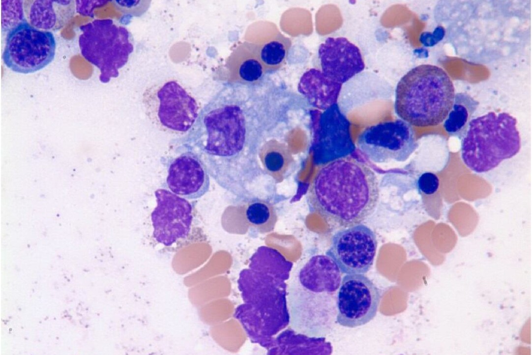 Hemophagocytic syndrome and macrophages